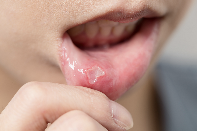 Understanding Canker Sores: Causes and Treatments